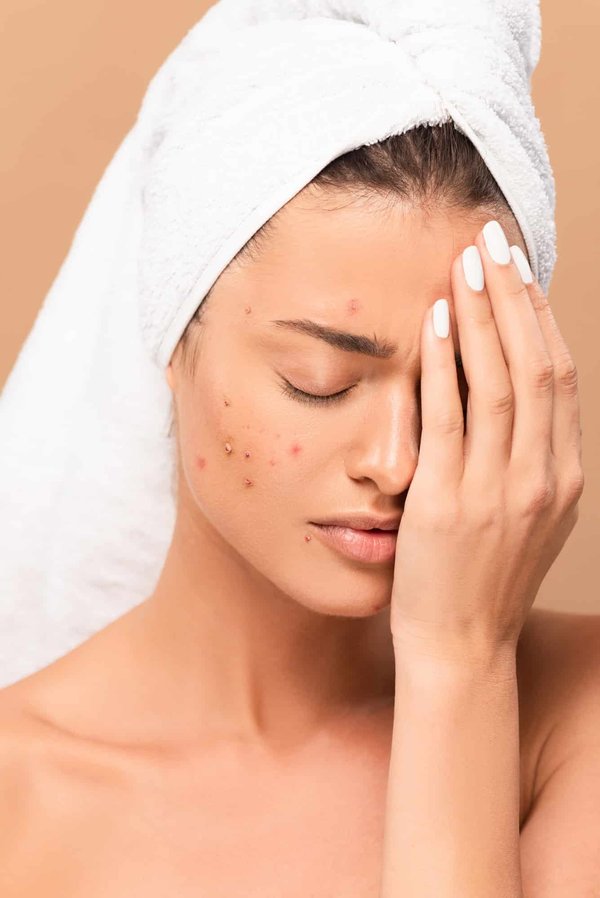 Comment se débarrasser des boutons d'acnés de façon naturelle ?