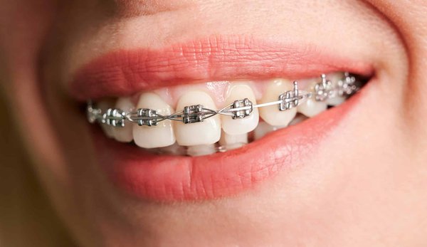 Quelles solutions pour les dents espacées à Saint-Jean-sur-Richelieu ?