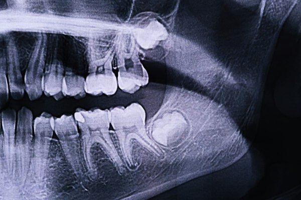 Comment traitez-vous les dents de sagesse à LaSalle ?